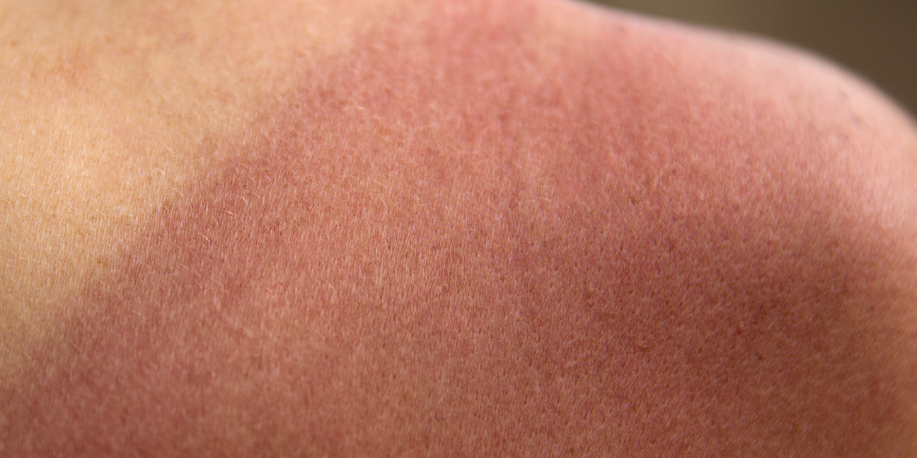 The Sun & UV Rays: The Risks of Sun Damage on our Skin